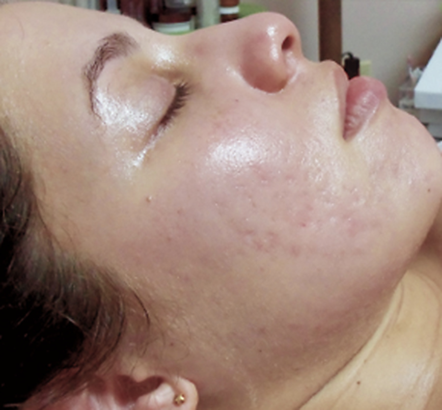 Nano infusion result, congestion and breakouts, after