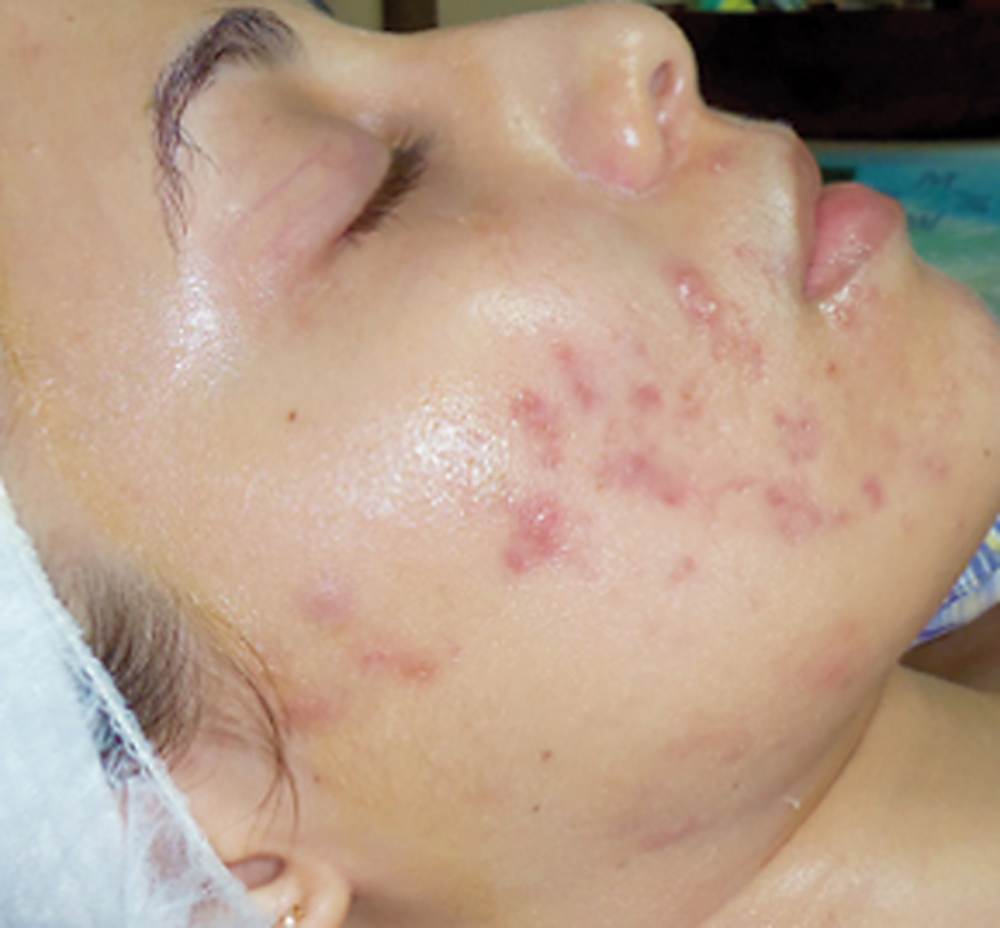 Nano infusion result, congestion and breakouts, before