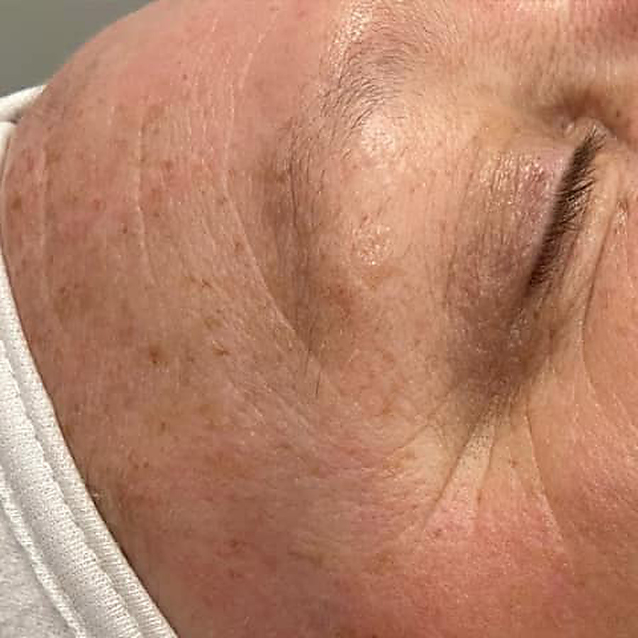 Nano infusion result, texture across the cheek, after