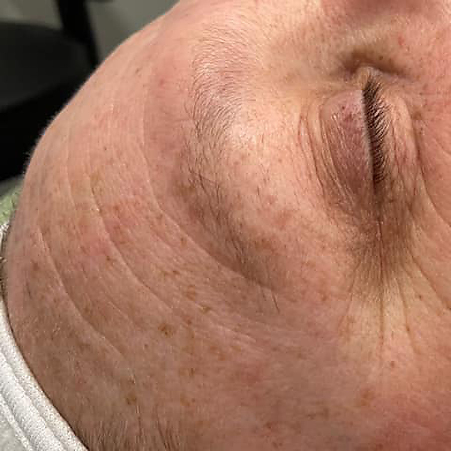Nano infusion result, texture across the cheek, before
