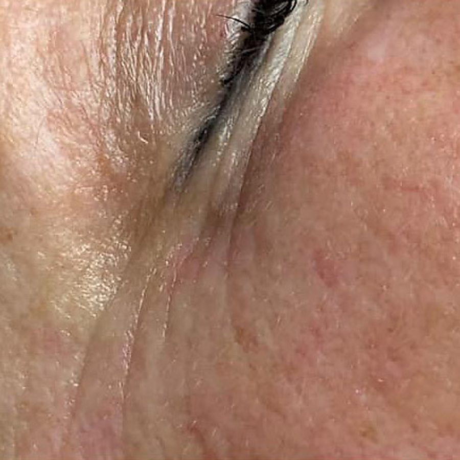Nano infusion result, fine lines at the outer eye, after