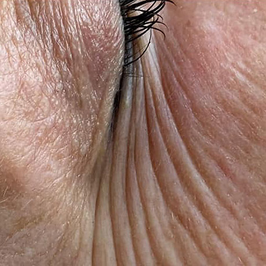 Nano infusion result, fine lines at the outer eye, before